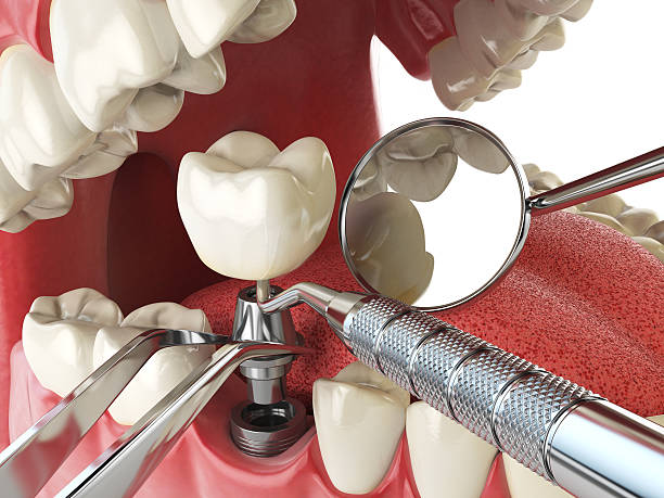 Best Emergency Dental Care for Broken or Chipped Teeth in Evergreen, AL